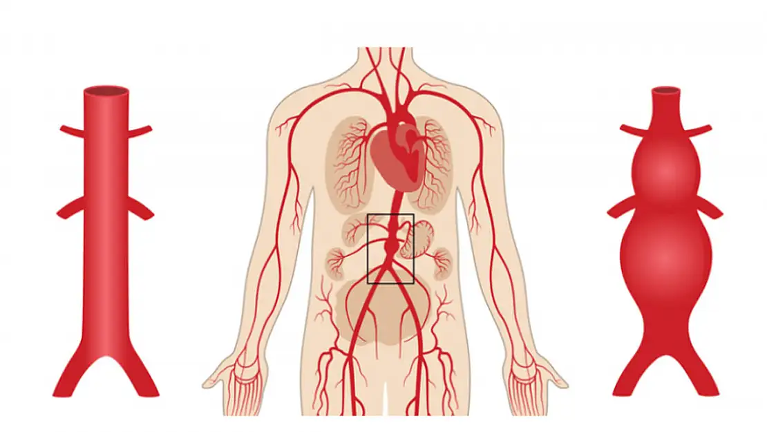 Aort Anevrizması Nedir?