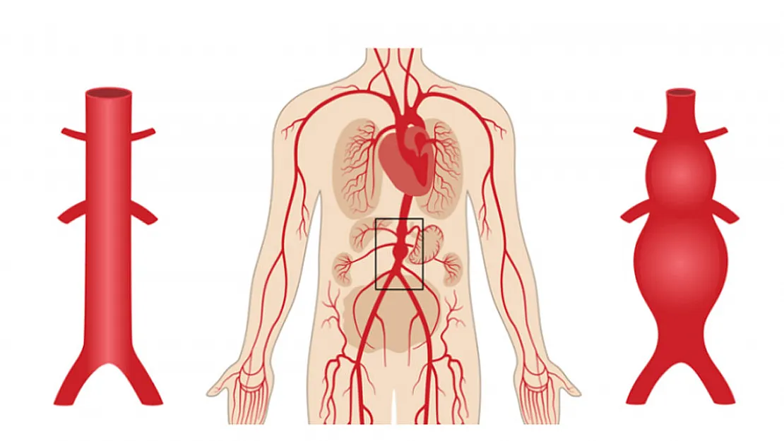 Aort Anevrizması Nedir?