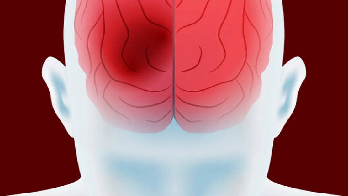 Beyin Kanaması: Sessiz Tehdit!