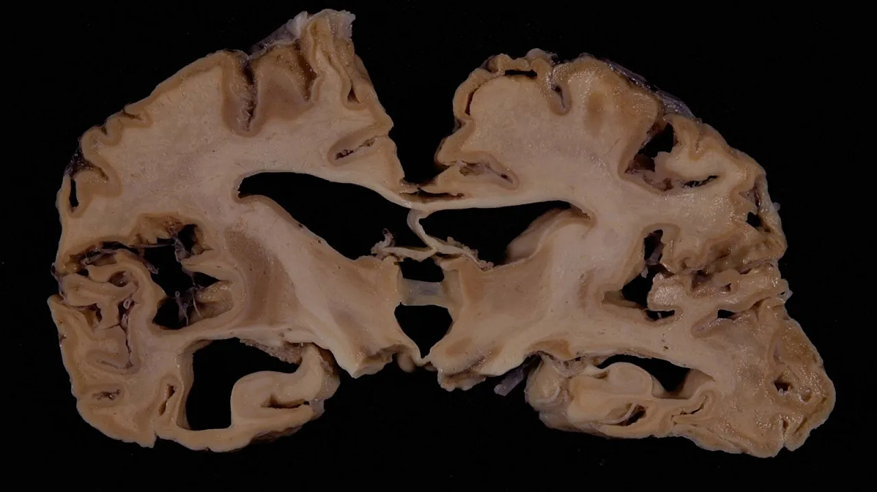 Deli Dana Hastalığı Vakası Tedirgin Ediyor