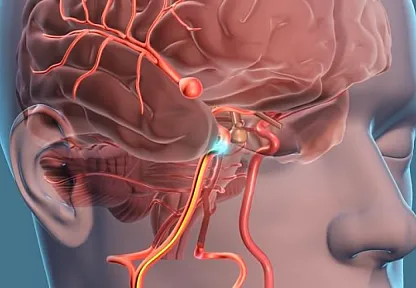 Beyin Anevrizması Nedir?