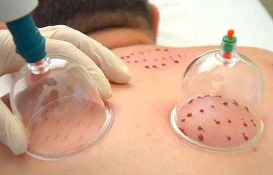 Hacamat İşlemi Ne İşe Yarar?