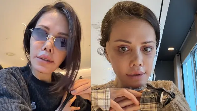 Didem Ceran'dan 'Yüz Nakli' Açıklaması