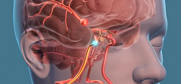 Beyin Anevrizması Nedir?