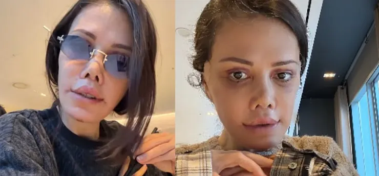 Didem Ceran'dan 'Yüz Nakli' Açıklaması